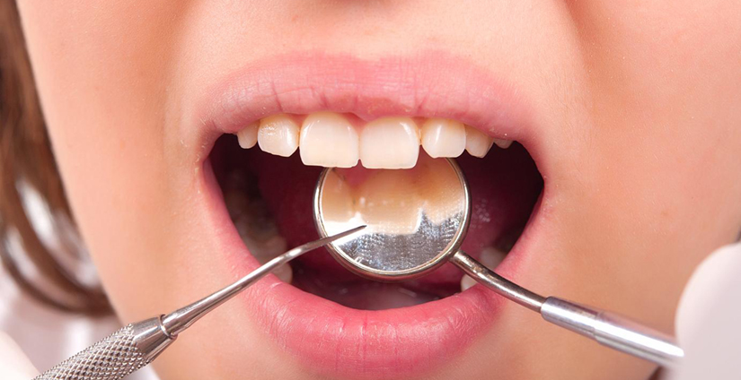 When do you need Dental fillers? – Community Smiles